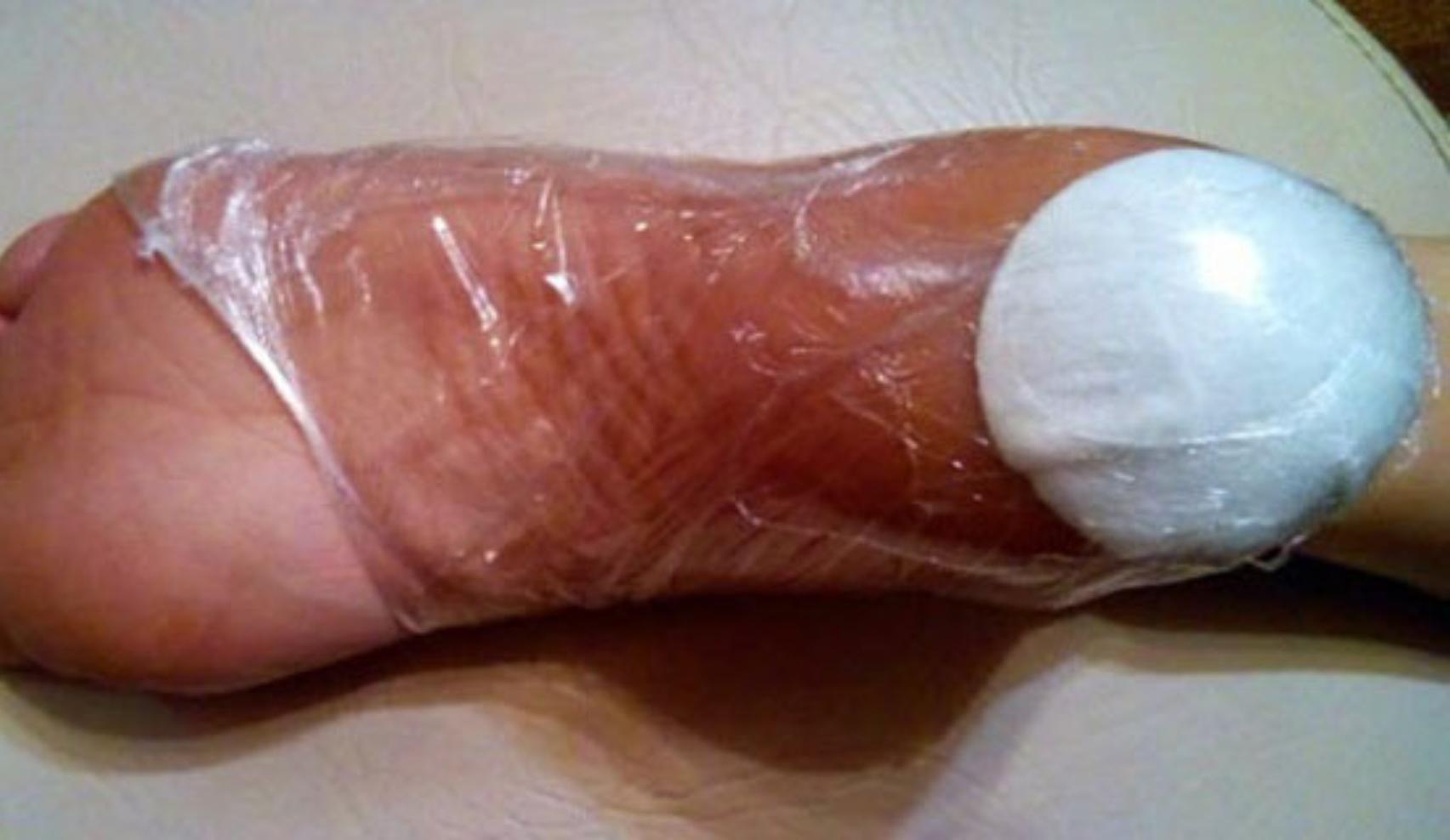 Σκασμένες φτέρνες ραγάδες και ξηροδερμία στις φτέρνες: Η σπιτική θεραπεία που θα τις κάνει να μοιάζουν βελούδινες