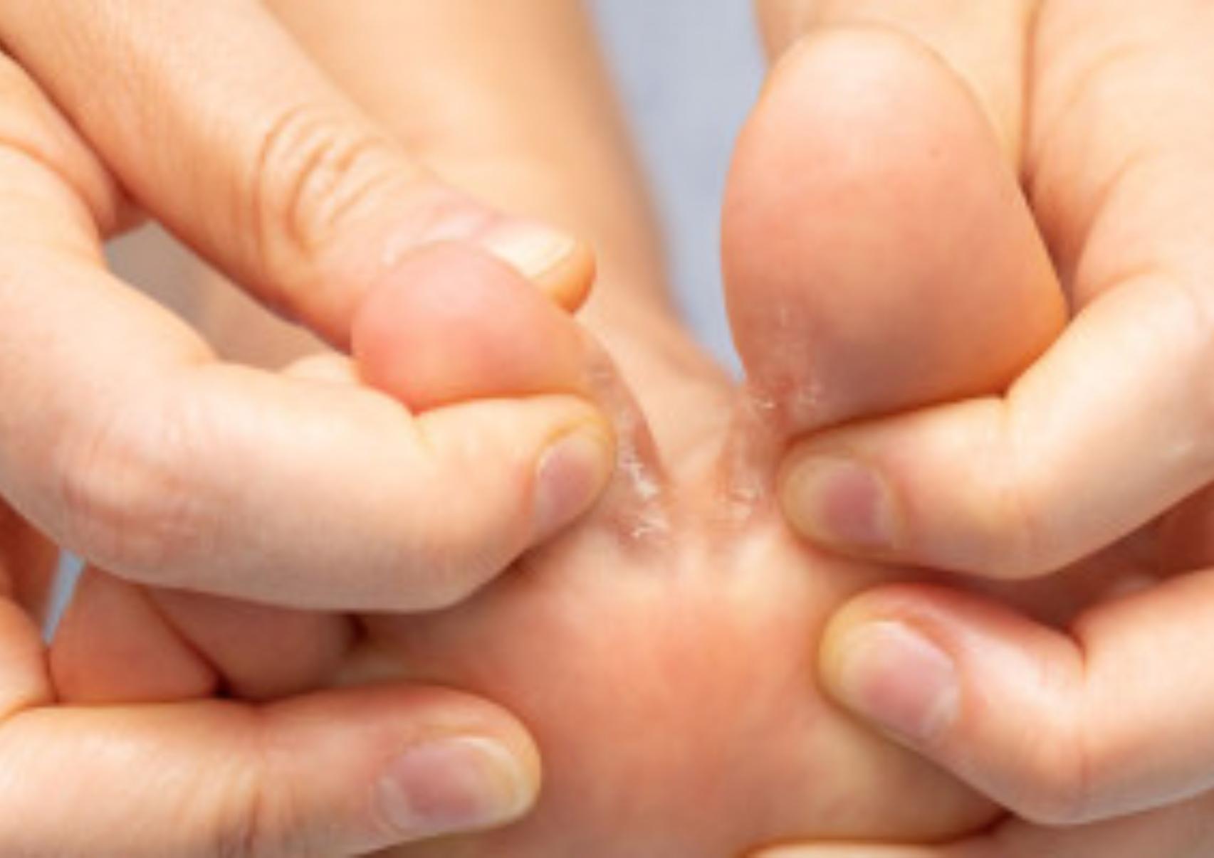 Το πόδι του αθλητή: Τι είναι ποια τα συμπτώματα ποια η θεραπεία και γιατί επιδεινώνεται το καλοκαίρι