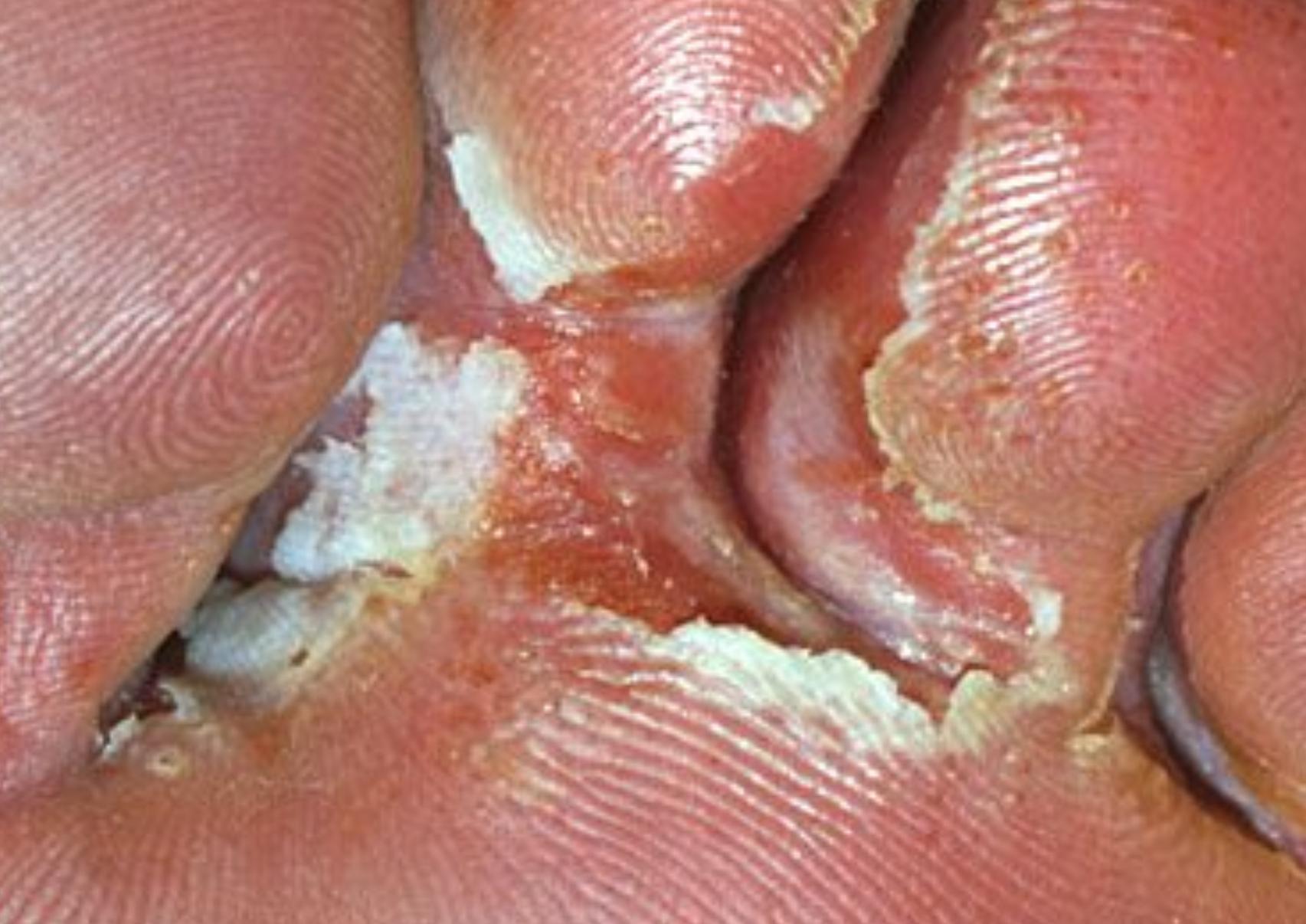 Το πόδι του αθλητή: Τι είναι ποια τα συμπτώματα ποια η θεραπεία και γιατί επιδεινώνεται το καλοκαίρι