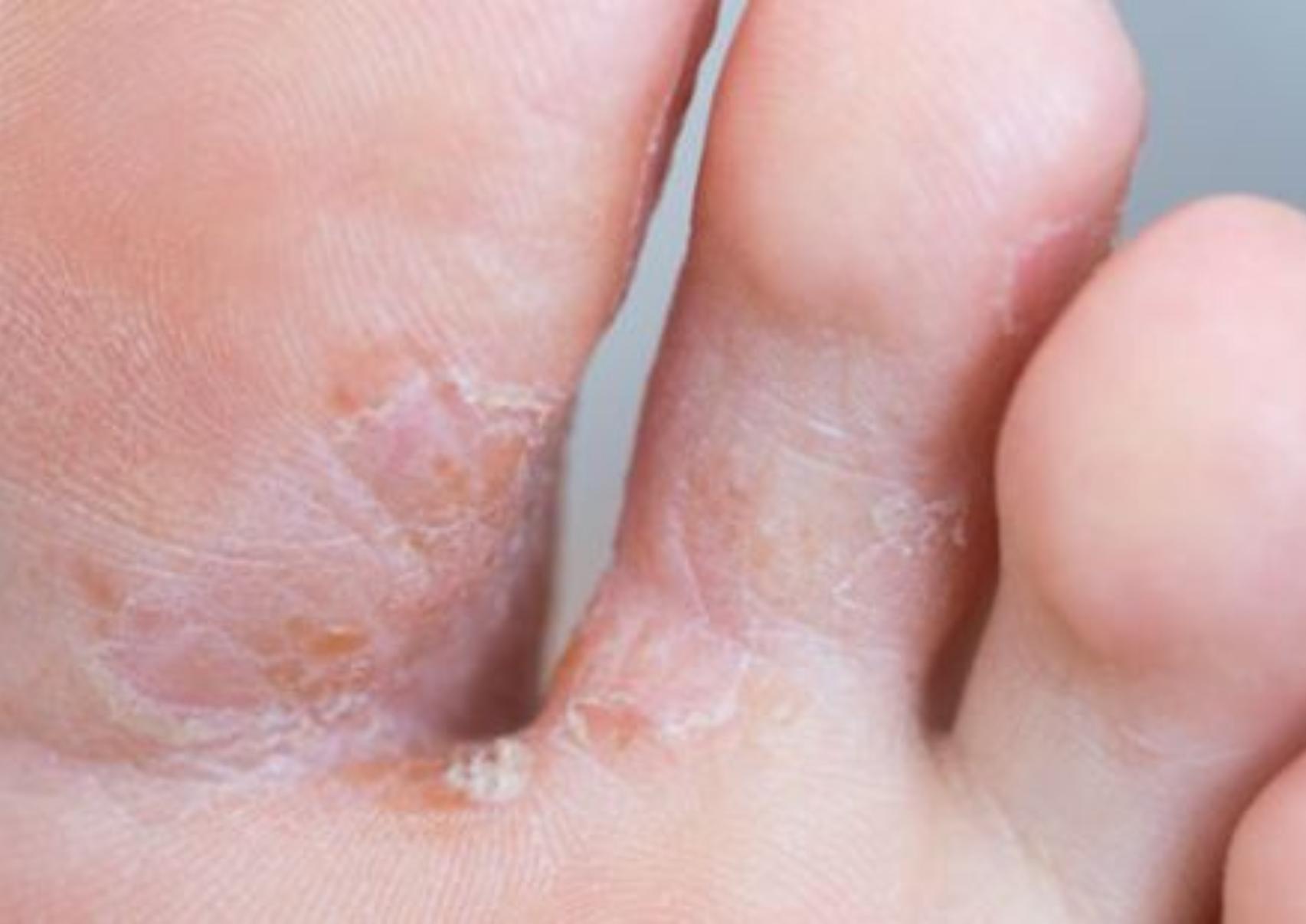 Το πόδι του αθλητή: Τι είναι ποια τα συμπτώματα ποια η θεραπεία και γιατί επιδεινώνεται το καλοκαίρι