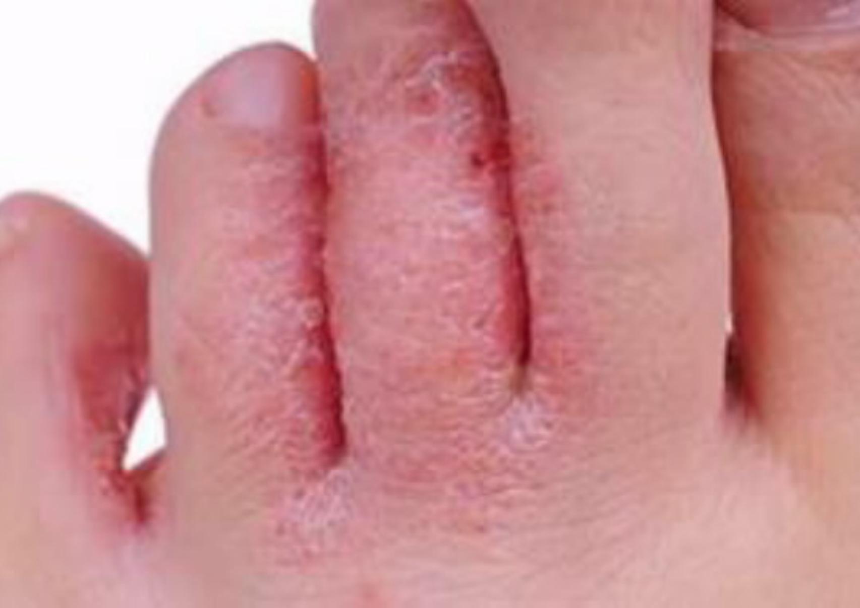 Το πόδι του αθλητή: Τι είναι ποια τα συμπτώματα ποια η θεραπεία και γιατί επιδεινώνεται το καλοκαίρι