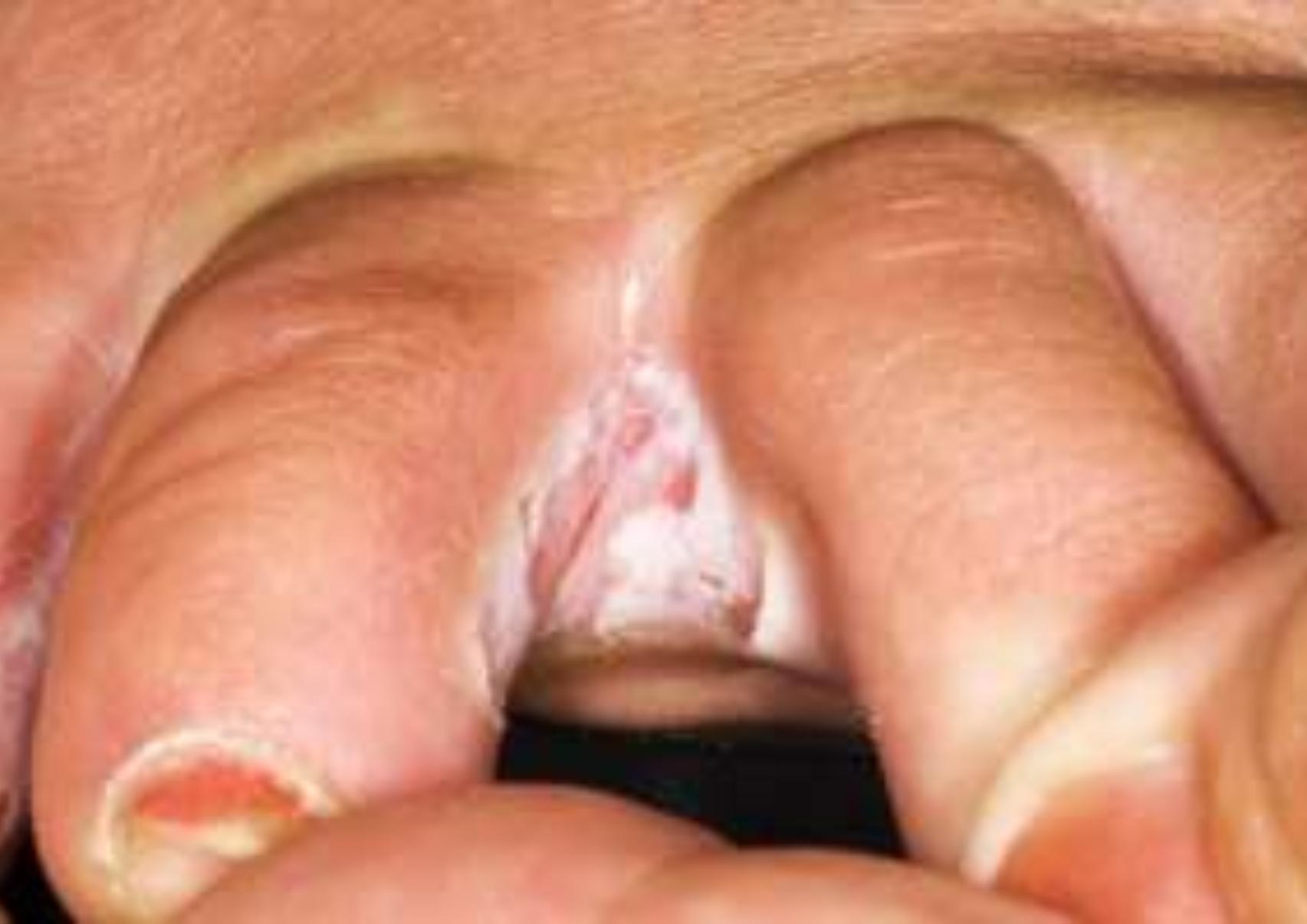 Το πόδι του αθλητή: Τι είναι ποια τα συμπτώματα ποια η θεραπεία και γιατί επιδεινώνεται το καλοκαίρι