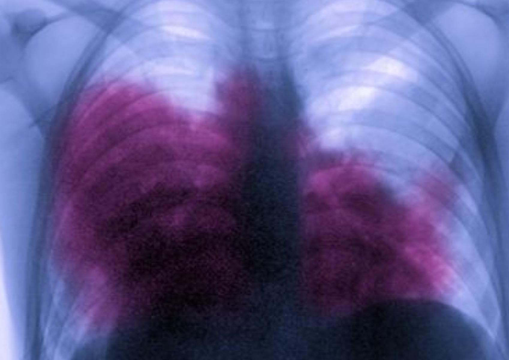 Nόσος των λεγεωναρίων ή Νόσος των Κλιματιστικών: Ποια τα αίτια ποια τα συμπτώματα και ποια η θεραπεία