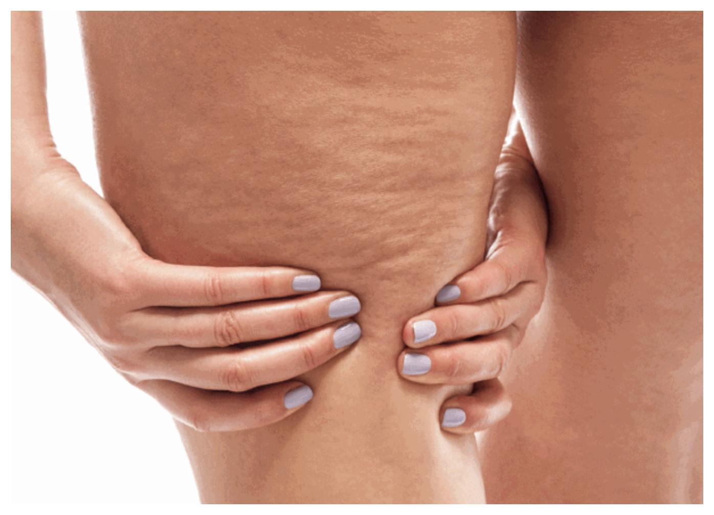 Το-άγχος-ευθύνεται-σημαντικά-για-την-εμφάνιση-της-κυτταρίτιδας-και-του-τοπικού-πάχους Το-άγχος-ευθύνεται-σημαντικά-για-την-εμφάνιση-της-κυτταρίτιδας-και-του-τοπικού-πάχους