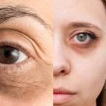 Μαύροι κύκλοι: Πως να τους εξαφανίσετε με καστορέλαιο