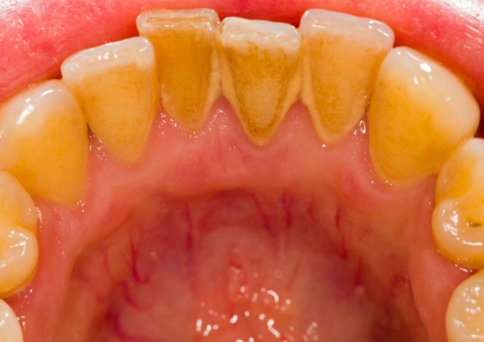 Κίτρινα δόντια με πλάκα και πέτρα: Φτιάξτε φυσικό στοματικό διάλυμα για να γίνουν και πάλι ολόλευκα και θα εξαφανίσει την δυσοσμία