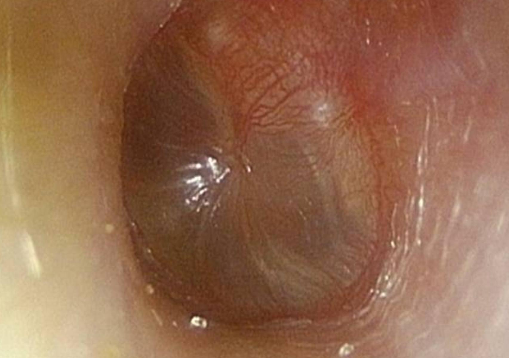 Ωτίτιδα το καλοκαίρι: Τι να προσέξετε και πως να την αντιμετωπίσετε