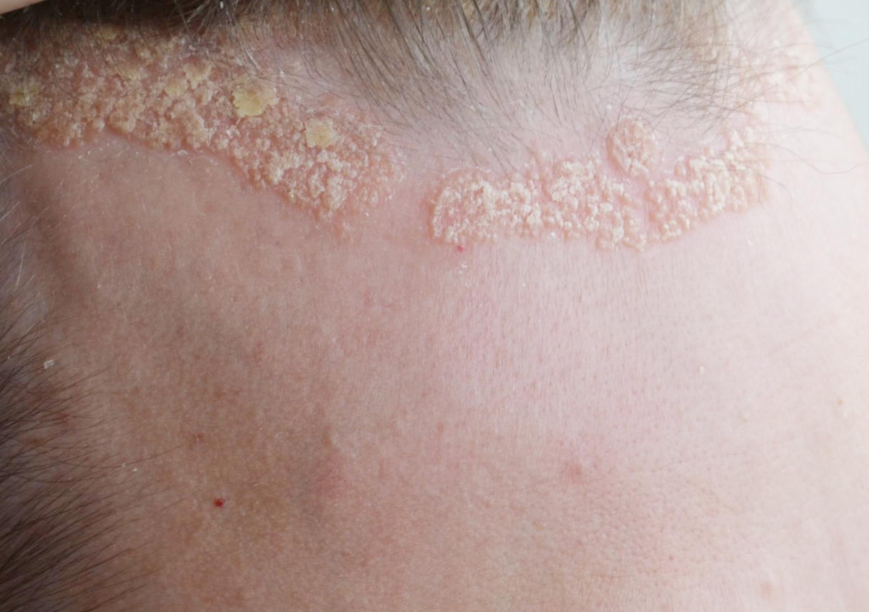 Ψωρίαση το καλοκαίρι: Πως βοηθά ο ήλιος και η θάλασσα