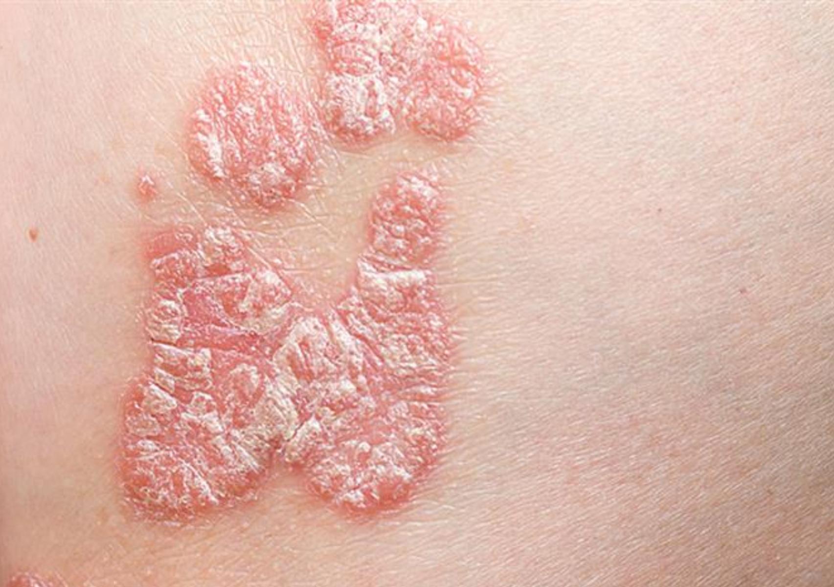 Ψωρίαση το καλοκαίρι: Πως βοηθά ο ήλιος και η θάλασσα