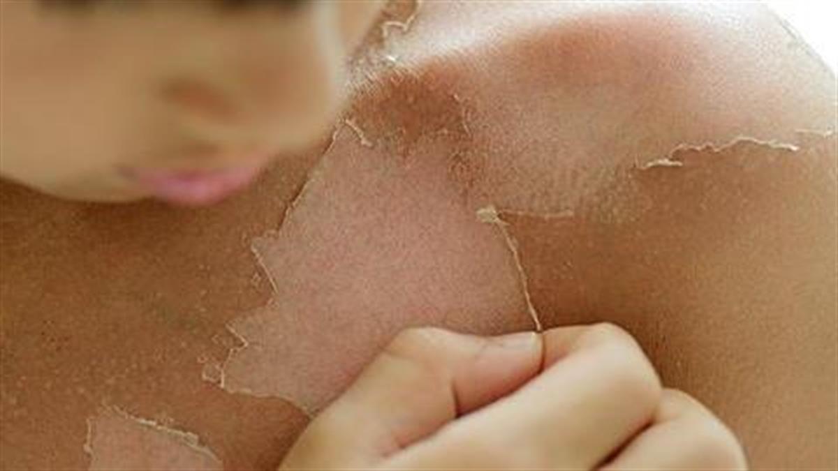 κόλπο-για-να-απαλλαγούμε-από-το-έγκαυμα-από-τον-ήλιο-και-το-ξεφλούδισμα- κόλπο-για-να-απαλλαγούμε-από-το-έγκαυμα-από-τον-ήλιο-και-το-ξεφλούδισμα-