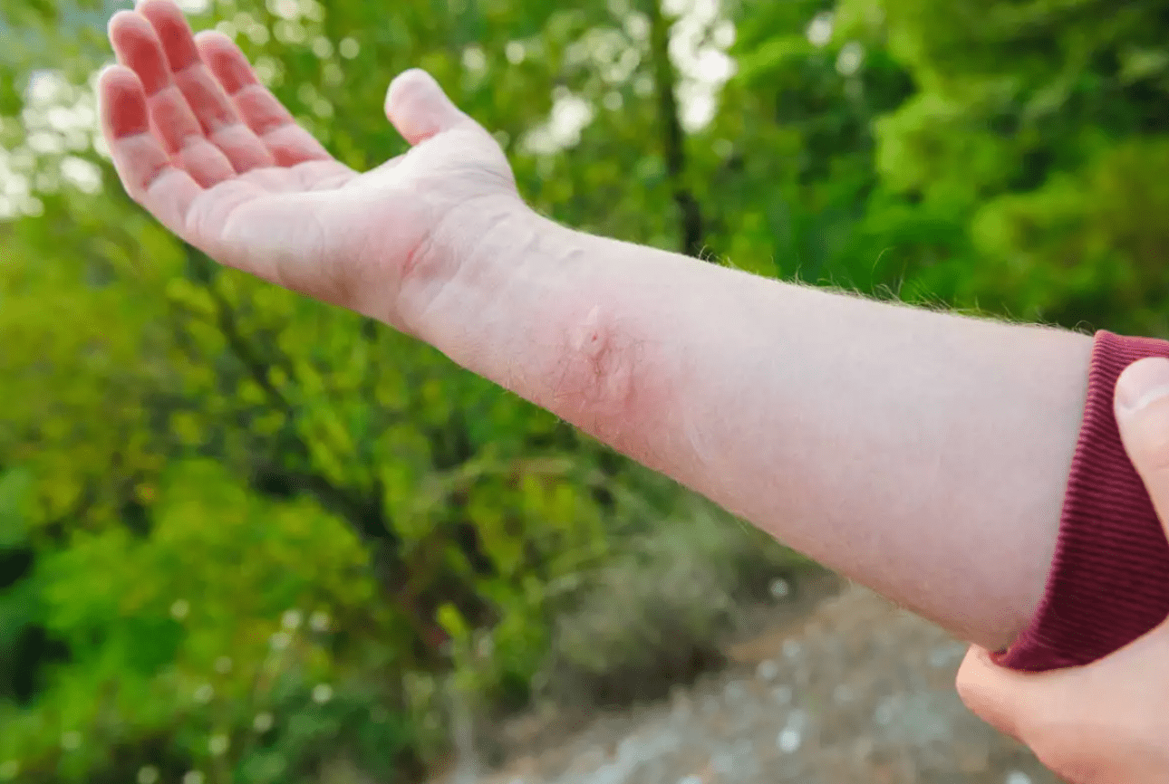 φυσικές-θεραπείες-για-τσίμπημα-από-κουνούπια-μέλισσες-σφήκες- φυσικές-θεραπείες-για-τσίμπημα-από-κουνούπια-μέλισσες-σφήκες-