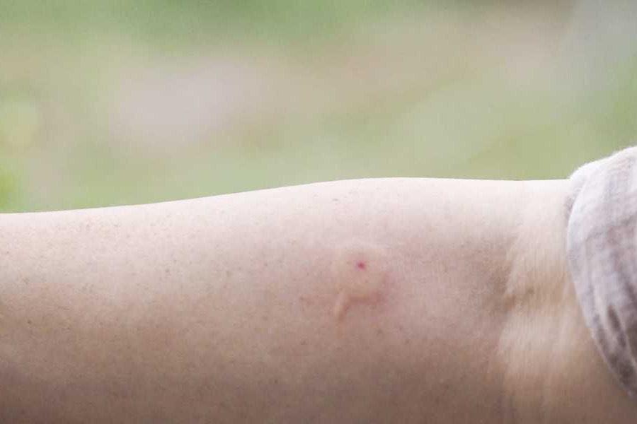 φυσικές-θεραπείες-για-τσίμπημα-από-κουνούπια-μέλισσες-σφήκες- φυσικές-θεραπείες-για-τσίμπημα-από-κουνούπια-μέλισσες-σφήκες-