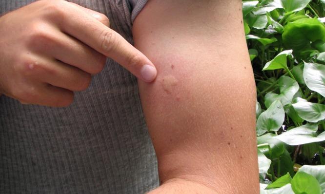 φυσικές-θεραπείες-για-τσίμπημα-από-κουνούπια-μέλισσες-σφήκες- φυσικές-θεραπείες-για-τσίμπημα-από-κουνούπια-μέλισσες-σφήκες-