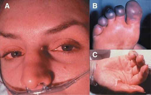 Τοξικό σοκ-από ταμπόν-συμπτώματα-κίνδυνοι-