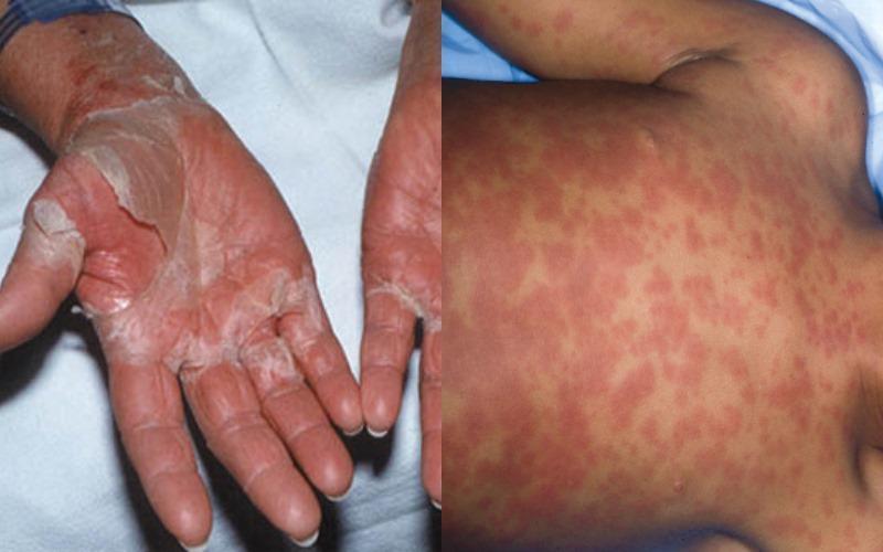 Τοξικό σοκ από ταμπόν: Τί μπορεί να πάθεις και οι κίνδυνοι