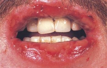 επικίνδυνα-δερματικά εξανθήματα-συμπτώματα-και-επιπλοκές- επικίνδυνα-δερματικά εξανθήματα-συμπτώματα-και-επιπλοκές-