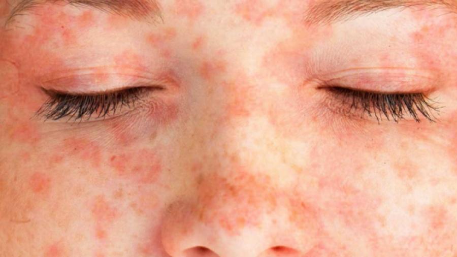 επικίνδυνα-δερματικά εξανθήματα-συμπτώματα-και-επιπλοκές- επικίνδυνα-δερματικά εξανθήματα-συμπτώματα-και-επιπλοκές-