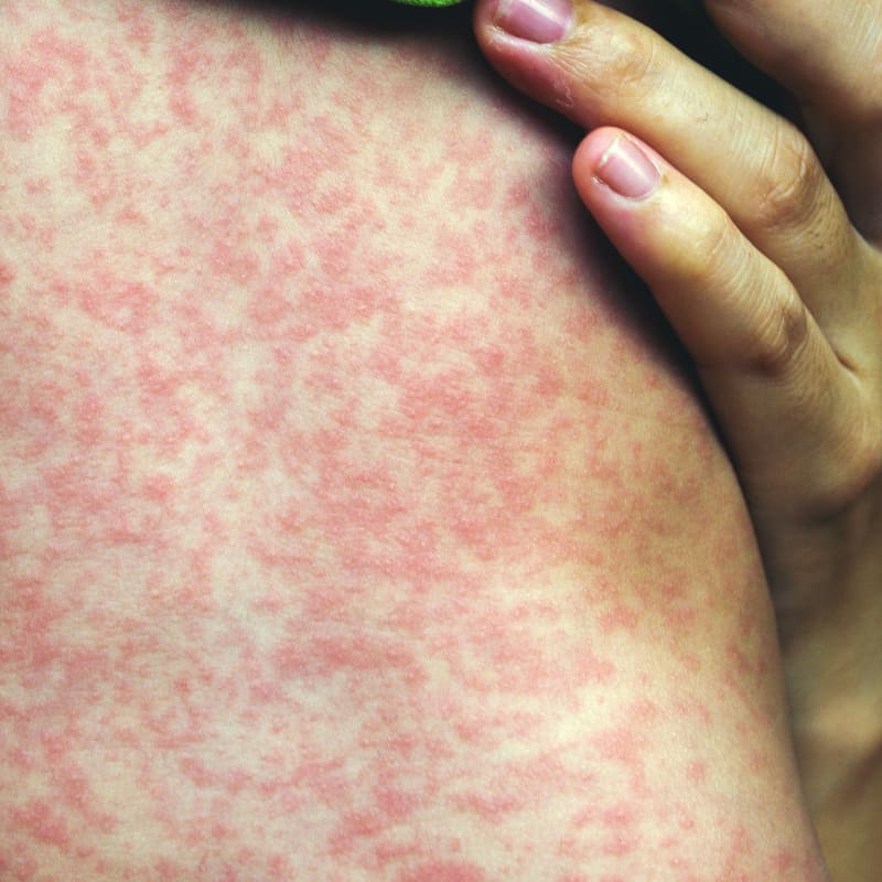 επικίνδυνα-δερματικά εξανθήματα-συμπτώματα-και-επιπλοκές- επικίνδυνα-δερματικά εξανθήματα-συμπτώματα-και-επιπλοκές-