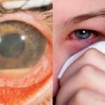 Πόνος στα μάτια και θολή όραση: Ποια είναι η φλεγμονή που προκαλεί τύφλωση και ποια τα συμπτώματα της.