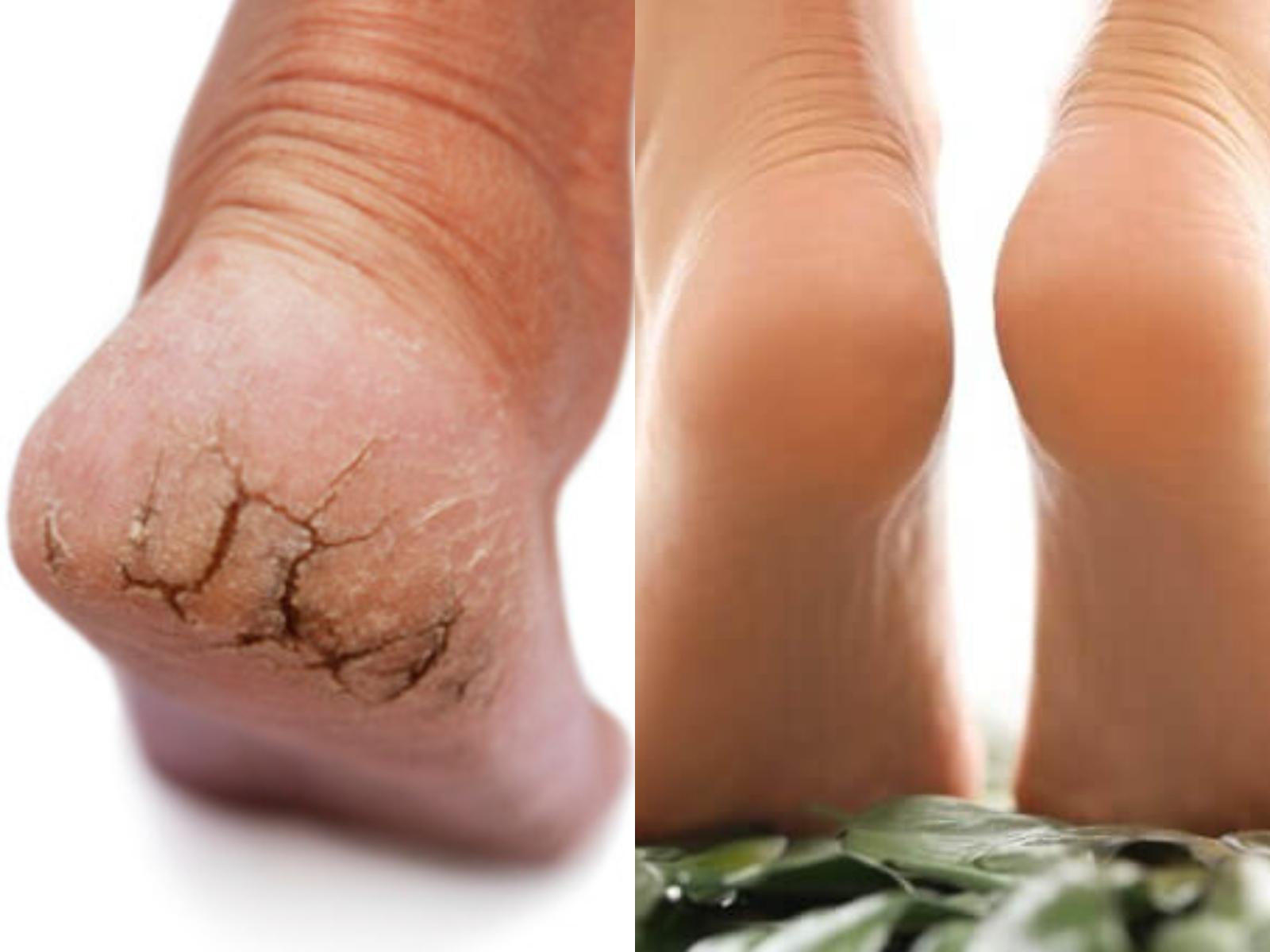 σκασμένες-φτέρνες-θεραπεία- σκασμένες-φτέρνες-θεραπεία-