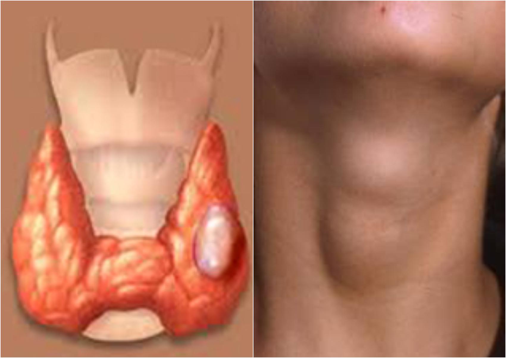 Οζώδης βρογχοκήλη: Τι είναι ποια τα συμπτώματα και ποια η θεραπεία