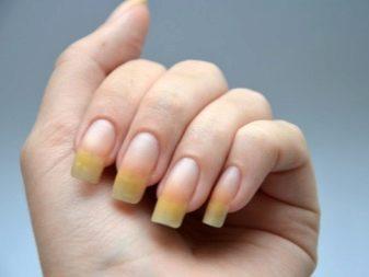 κιτρινισμένα νύχια-αίτια-και-αντιμετώπιση- κιτρινισμένα νύχια-αίτια-και-αντιμετώπιση-