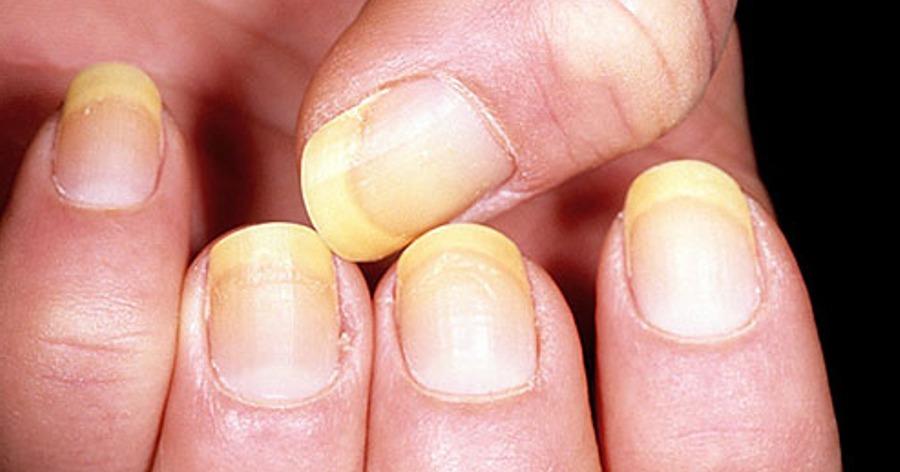 κιτρινισμένα νύχια-αίτια-και-αντιμετώπιση- κιτρινισμένα νύχια-αίτια-και-αντιμετώπιση-