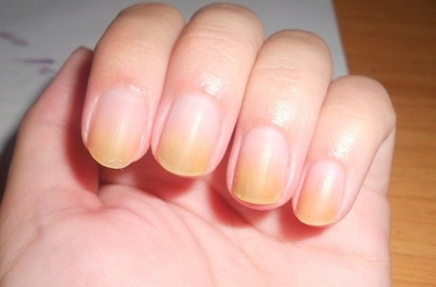 κιτρινισμένα νύχια-αίτια-και-αντιμετώπιση- κιτρινισμένα νύχια-αίτια-και-αντιμετώπιση-