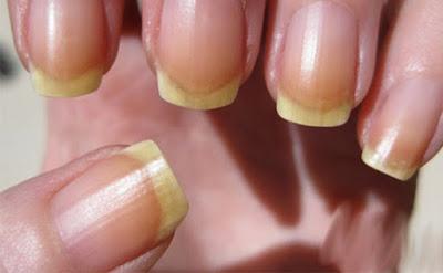 κιτρινισμένα νύχια-αίτια-και-αντιμετώπιση- κιτρινισμένα νύχια-αίτια-και-αντιμετώπιση-