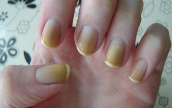 κιτρινισμένα νύχια-αίτια-και-αντιμετώπιση- κιτρινισμένα νύχια-αίτια-και-αντιμετώπιση-
