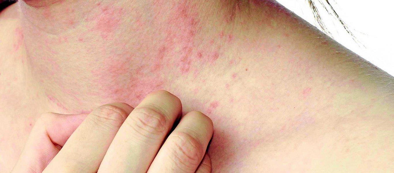 ακάρι-της-ψώρας- ακάρι-της-ψώρας-