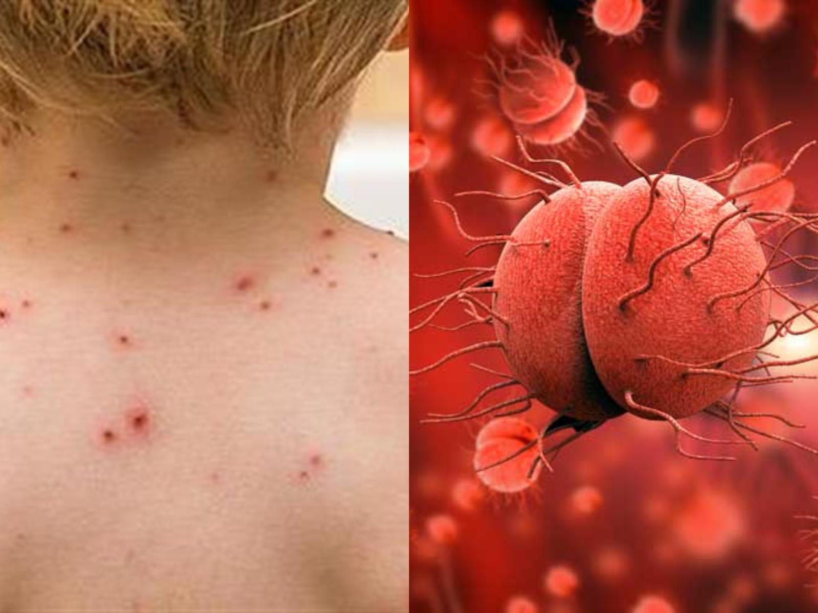 Κεραυνοβόλος μηνιγγίτιδα : Μεγάλη επικινδυνότητα για τα παιδιά- Ποια τα συμπτώματα της