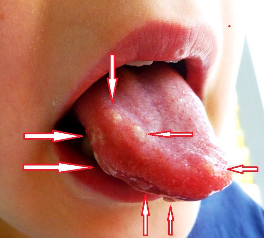 άφθες-σε-παιδιά