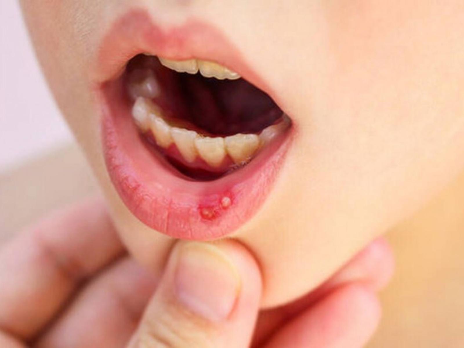 Άφθες σε παιδιά: Τα επικίνδυνα συμπτώματα που πρέπει να προσέχουν οι γονείς-Πως θα φύγουν οριστικά