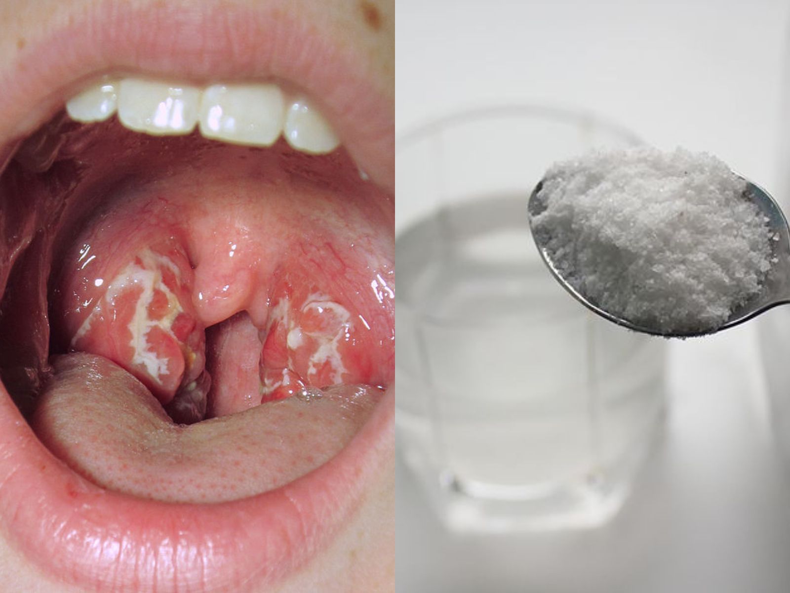 Πονόλαιμος: 6+1 λόγοι που πονάει ο λαιμός μας το πρωί-Σπιτικές θεραπείες για να ανακουφιστείτε