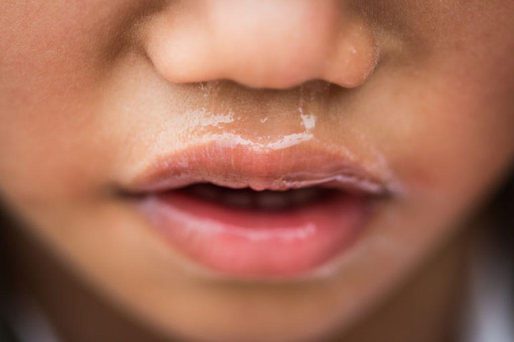 Μύξα-στα-παιδιά-7-τρόποι-αντιμετώπισης Μύξα-στα-παιδιά-7-τρόποι-αντιμετώπισης