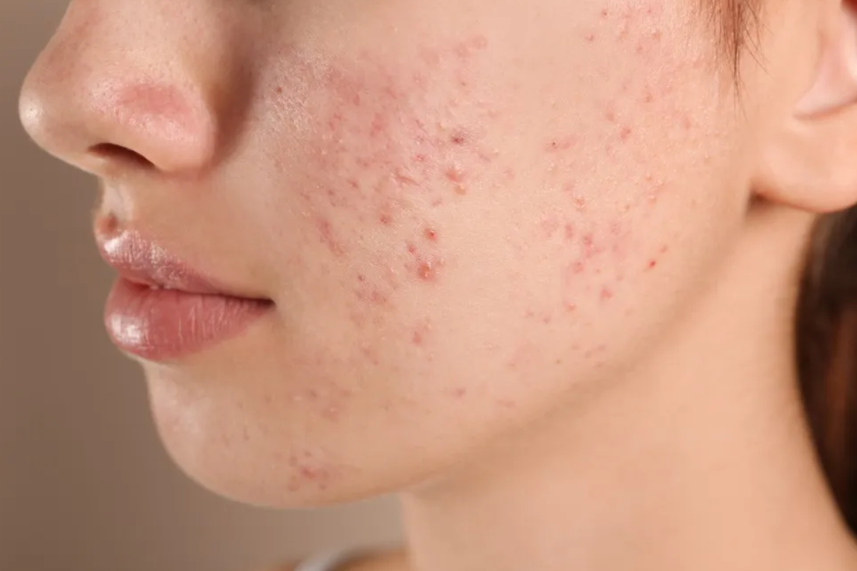 Καστορέλαιο-φυσικό-καλλυντικό-για-ακμή-ρυτίδες-και-φλεγμονές- Καστορέλαιο-φυσικό-καλλυντικό-για-ακμή-ρυτίδες-και-φλεγμονές-