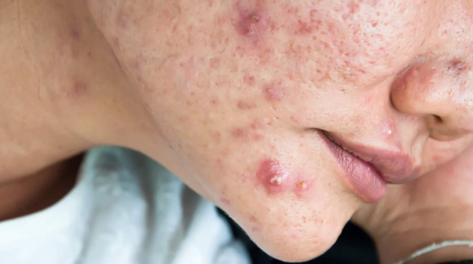 Καστορέλαιο-φυσικό-καλλυντικό-για-ακμή-ρυτίδες-και-φλεγμονές- Καστορέλαιο-φυσικό-καλλυντικό-για-ακμή-ρυτίδες-και-φλεγμονές-