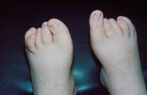 Νεανική ιδιοπαθής αρθρίτιδα-συμπτώματα-αίτια-αντιμετώπιση-