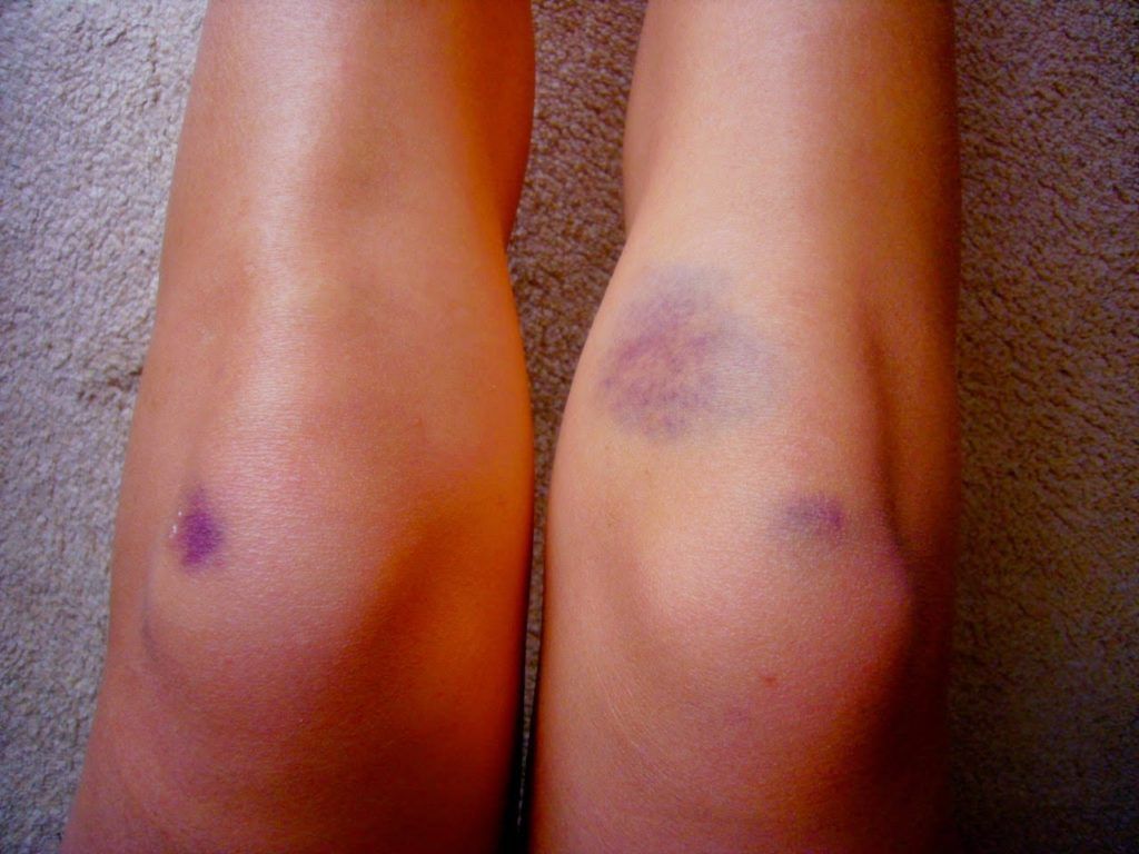 Μελανιές-5-λόγοι-που-εμφανίζουμε-συχνά Μελανιές-5-λόγοι-που-εμφανίζουμε-συχνά