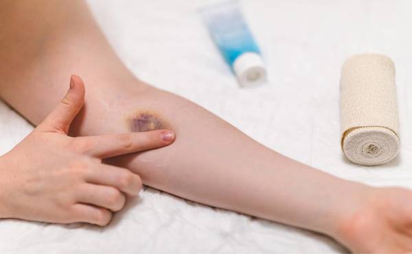 Μελανιές-5-λόγοι-που-εμφανίζουμε-συχνά Μελανιές-5-λόγοι-που-εμφανίζουμε-συχνά