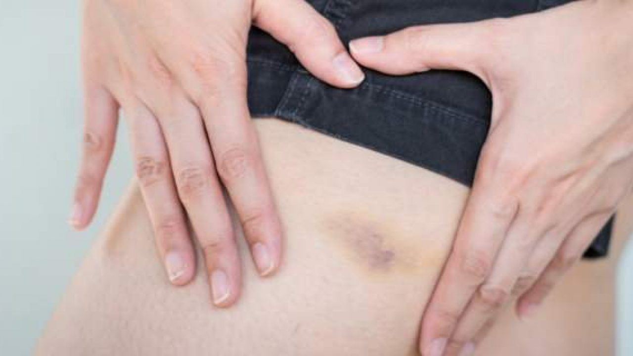 Μελανιές-5-λόγοι-που-εμφανίζουμε-συχνά Μελανιές-5-λόγοι-που-εμφανίζουμε-συχνά