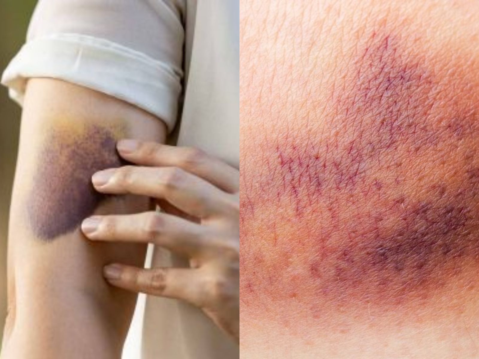 Μελανιές στο σώμα: 4+1 λόγοι που εμφανίζουμε συχνά μώλωπες