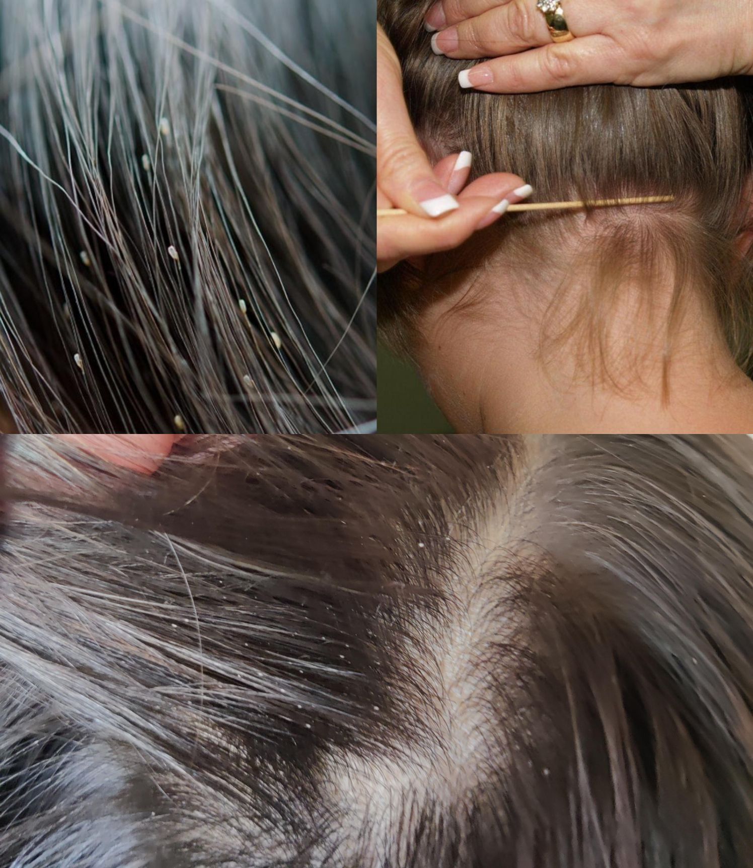 Η Δραστική σπιτική θεραπεία που θα αφαιρέσει τις κόνιδες από το κεφάλι του παιδιού με μία εφαρμογή