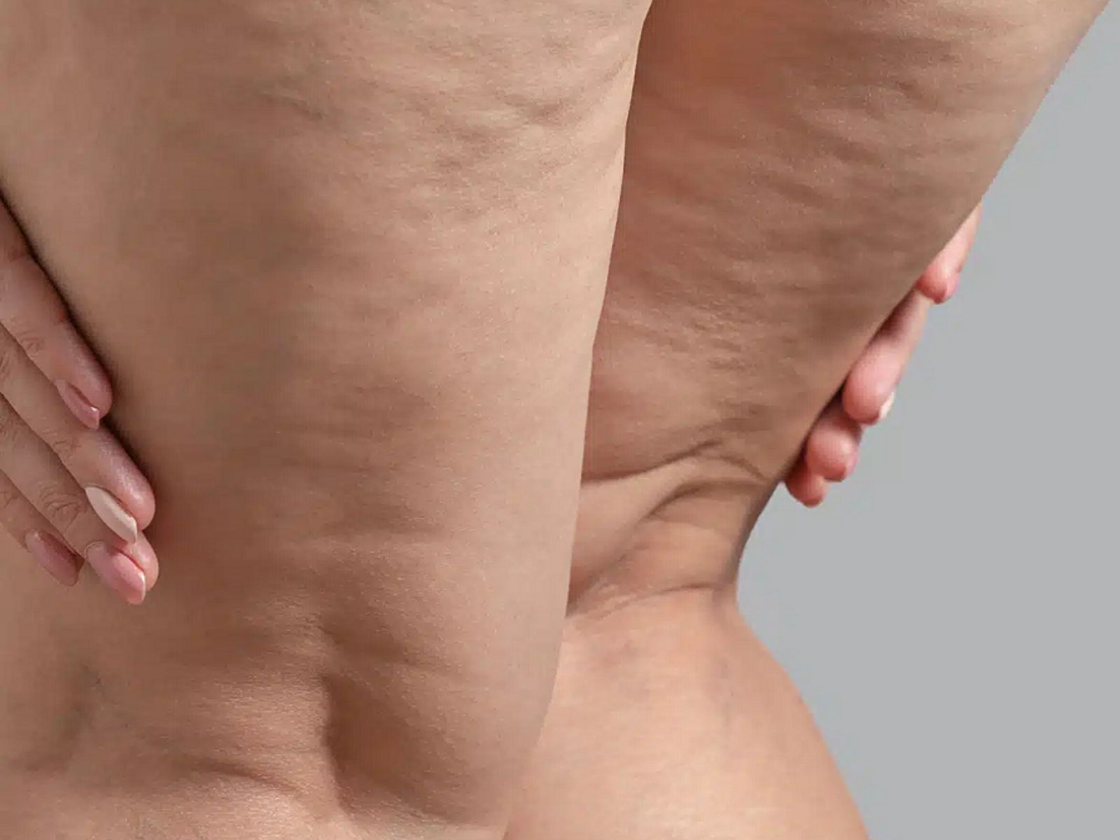 Κορτιζόλη- Η ορμόνη του στρες που συμβάλλει στην εμφάνιση κυτταρίτιδας και τοπικού λίπους-μν το πειραξετε