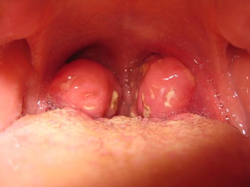 Αμυγδαλές : 11 τρόποι για να απαλλαγείτε από τα λευκά κομμάτια