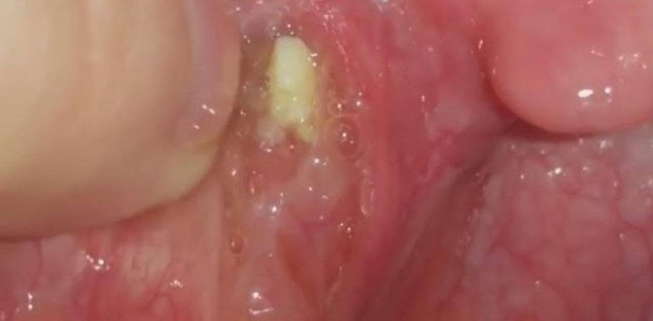 Αμυγδαλές : 11 τρόποι για να απαλλαγείτε από τα λευκά κομμάτια