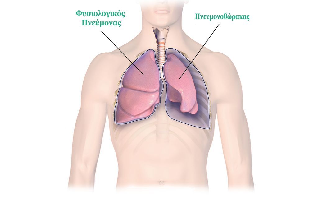Πνευμοθώρακας: Όταν ο αέρας από τους πνεύμονες πηγαίνει στον θώρακα – Κίνδυνοι και αίτια (ΔΕΝξερω τι ειναι