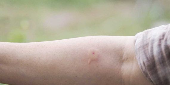 Αλλεργία στο τσίμπημα τις μέλισσας – Τα συμπτώματα και τρόποι να τα αντιμετωπίσεις πριν πας στον γιατρό