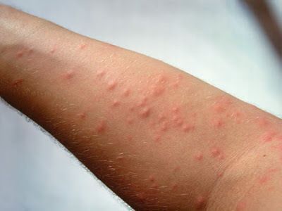 δερματίτιδα-από-κάμπιες-αντιμετώπιση-συμπτώματα- δερματίτιδα-από-κάμπιες-αντιμετώπιση-συμπτώματα-